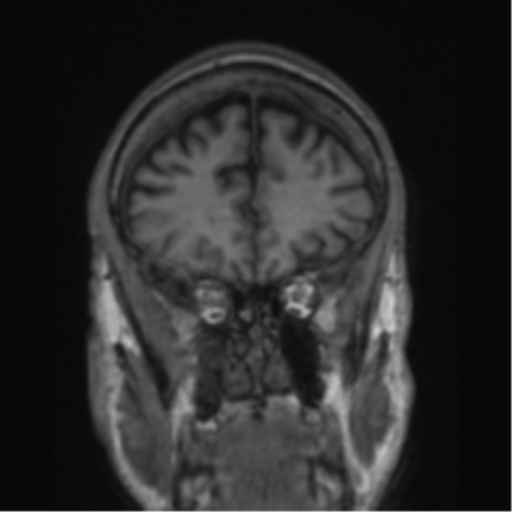 File:Alzheimer's disease- with apraxia (Radiopaedia 54763-61011 Coronal T1 71).png