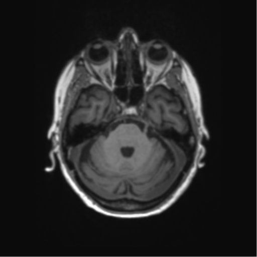 File:Alzheimer's disease (Radiopaedia 42658-45802 Axial T1 111).png