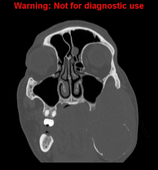File:Ameloblastoma (Radiopaedia 13276-13280 Coronal non-contrast 8).jpg