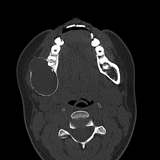 File:Ameloblastoma (Radiopaedia 26645-26793 E 34).jpg