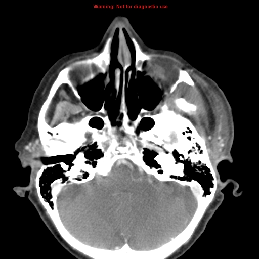 Ameloblastoma (Radiopaedia 27437-27631 A 8).jpg