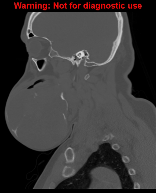 Ameloblastoma (Radiopaedia 33126-34164 Sagittal bone window 28).jpg