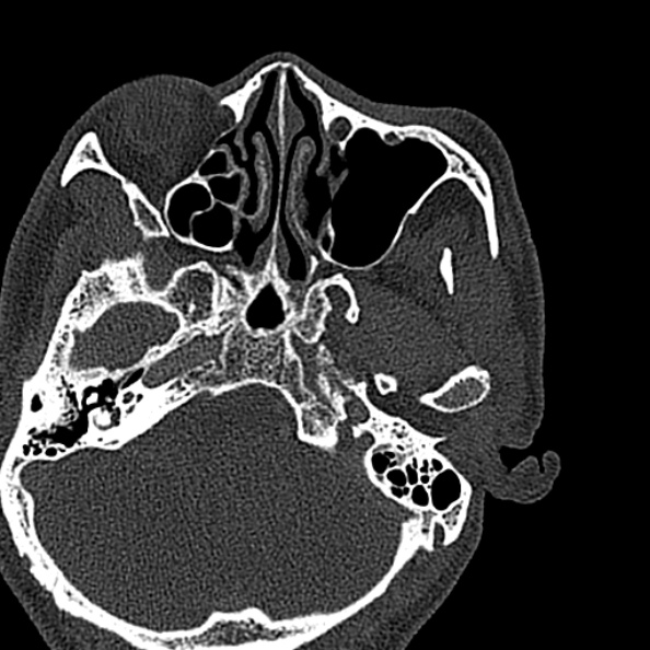 Ameloblastoma (Radiopaedia 51921-57766 Axial bone window 149).jpg