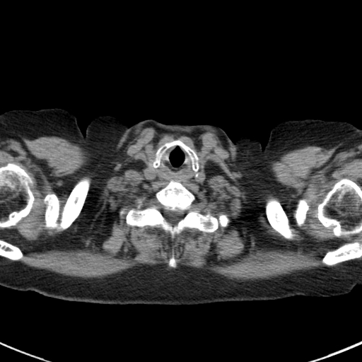 File:Amiodarone-induced pulmonary fibrosis (Radiopaedia 82355-96460 Axial non-contrast 4).jpg
