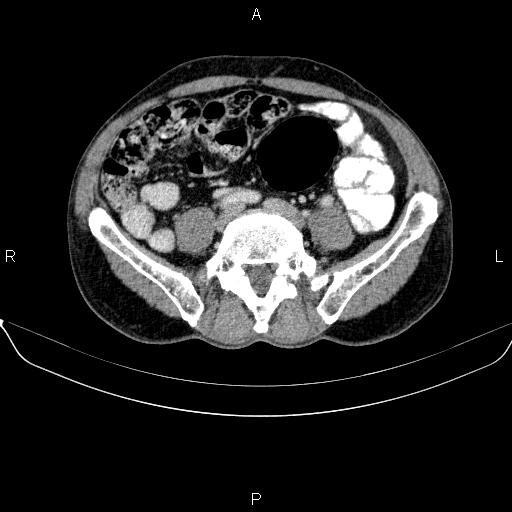 Ampullary adenocarcinoma (Radiopaedia 86093-102032 A 40).jpg