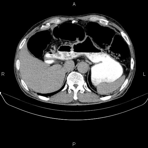 Ampullary adenocarcinoma (Radiopaedia 86093-102032 Axial C+ delayed 22).jpg