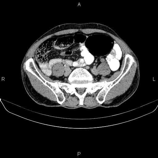 Ampullary adenocarcinoma (Radiopaedia 86093-102032 Axial C+ delayed 76).jpg