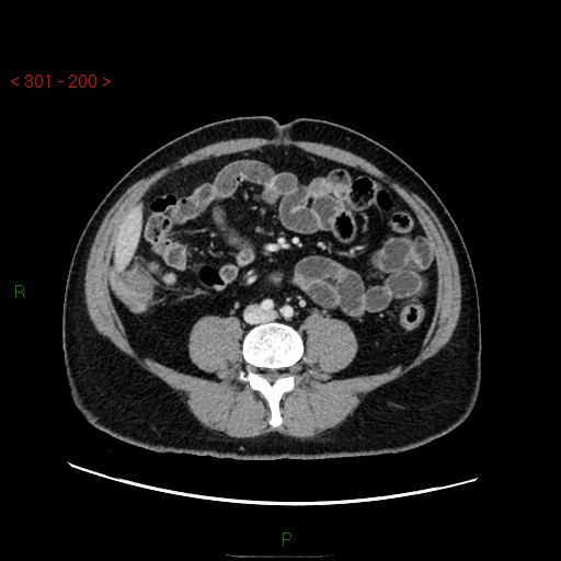Ampullary carcinoma (Radiopaedia 56396-63056 C 61).jpg