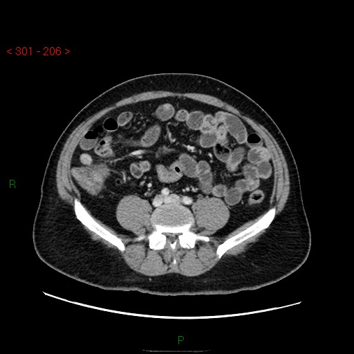Ampullary carcinoma (Radiopaedia 56396-63056 C 65).jpg