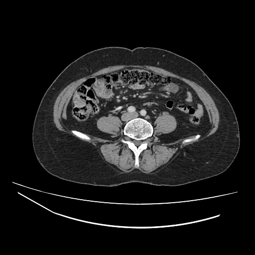 Ampullary tumor (Radiopaedia 60333-67998 A 54).jpg