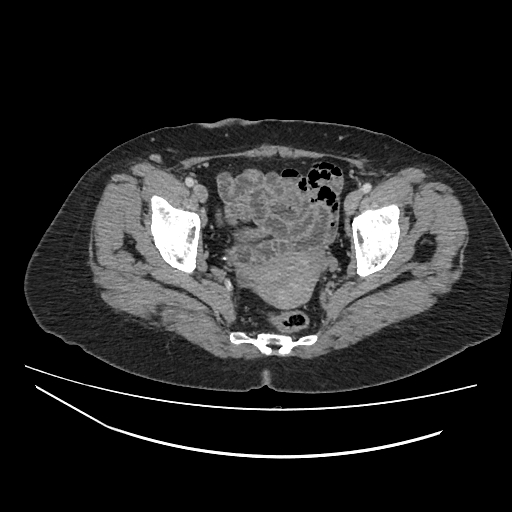 Ampullary tumor (Radiopaedia 60333-67998 A 81).jpg