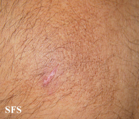 Amyloidosis-Macular Amyloidosis (Dermatology Atlas 5).jpg