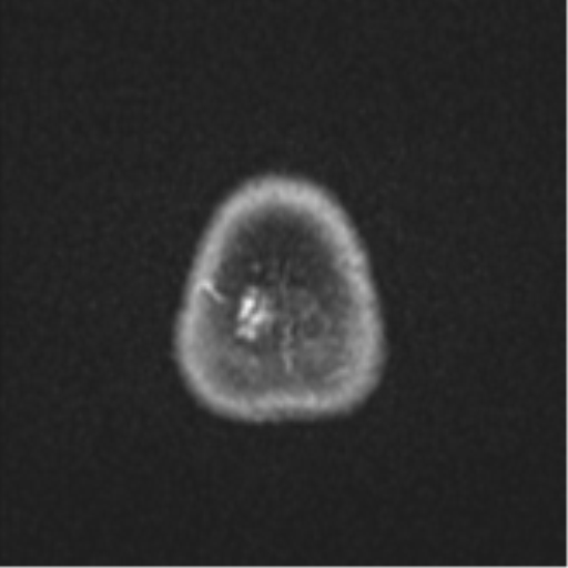 Anaplastic astroblastoma (Radiopaedia 55666-62194 Axial DWI 28).png
