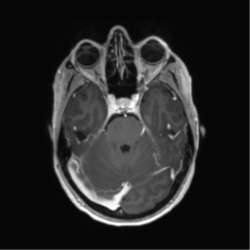 File:Anaplastic astrocytoma IDH mutant (Radiopaedia 50046-55341 Axial T1 C+ 17).png