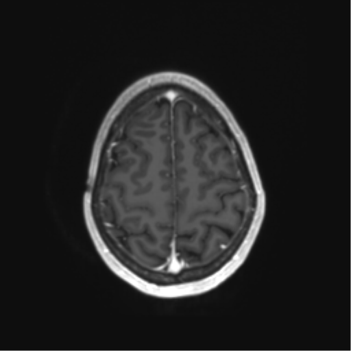 File:Anaplastic astrocytoma IDH mutant (Radiopaedia 50046-55341 Axial T1 C+ 41).png