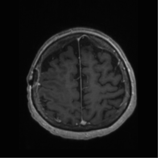 File:Anaplastic astrocytoma IDH wild-type (pseudoprogression) (Radiopaedia 42209-45277 Axial T1 C+ 100).png