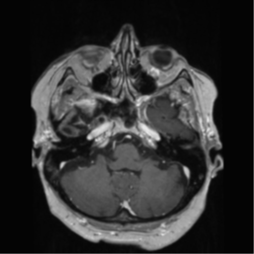 File:Anaplastic astrocytoma IDH wild-type (pseudoprogression) (Radiopaedia 42209-45278 Axial T1 C+ 44).png