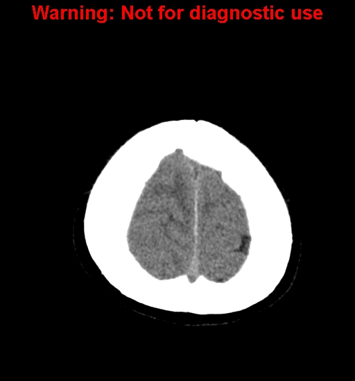File:Anaplastic ganglioglioma (Radiopaedia 44921-48815 Axial non-contrast 26).jpg