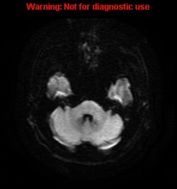 File:Anaplastic ganglioglioma (Radiopaedia 44921-48831 Axial DWI 6).jpg