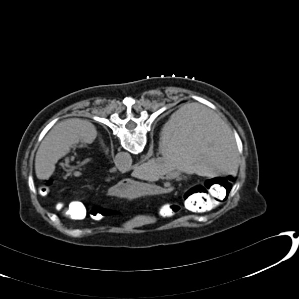 File:Anaplastic lymphoma - with CT biopsy (Radiopaedia 21643-21602 Axial non-contrast 5).jpg