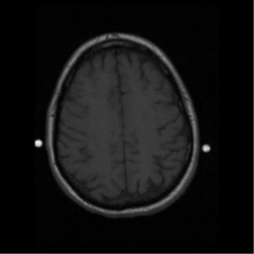 File:Anaplastic meningioma with recurrence (Radiopaedia 34452-35783 Axial T1 16).png