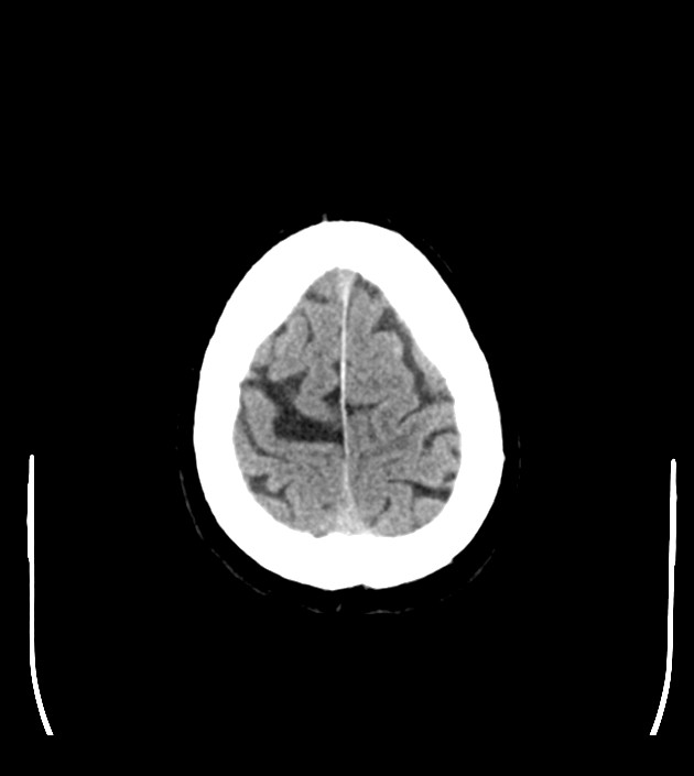 Anaplastic oligodendroglioma (Radiopaedia 79571-92753 Axial non-contrast 47).jpg
