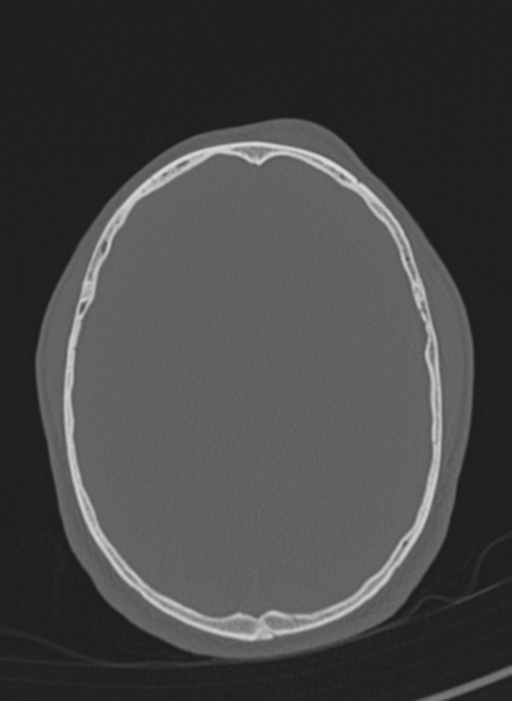 Anaplastic oligodendroglioma with skull fracture (Radiopaedia 74831-85846 Axial bone window 17).png