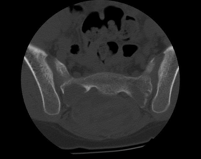 Aneurysmal bone cyst - sacrum (Radiopaedia 65190-74195 Axial bone window 25).jpg