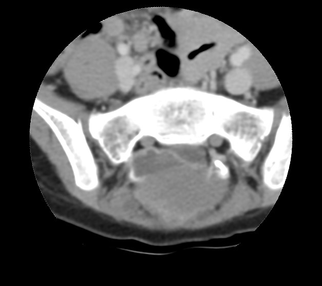 Aneurysmal bone cyst - sacrum (Radiopaedia 65190-74195 Axial non-contrast 19).jpg