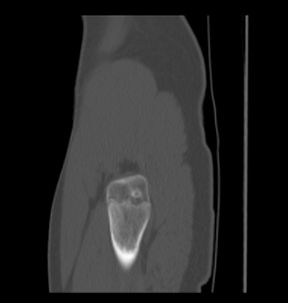 Aneurysmal bone cyst of ischium (Radiopaedia 25957-26094 Sagittal bone window 68).png
