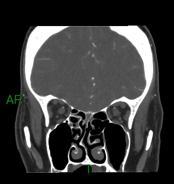 Aneurysmal subarachnoid hemorrhage with intra-axial extension (Radiopaedia 84371-99732 C 74).jpg
