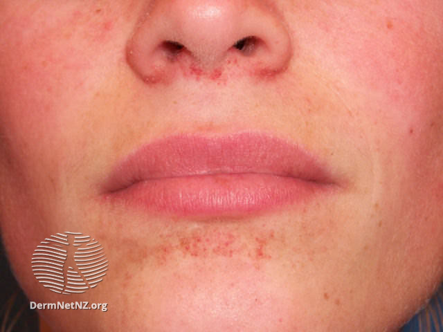 File:Angiofibromas in tuberous sclerosis (DermNet NZ systemic-angiofibromas-12).jpg