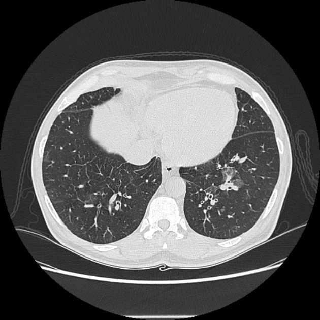Angioinvasive aspergellosis (Radiopaedia 66995-76315 Axial lung window 39).jpg