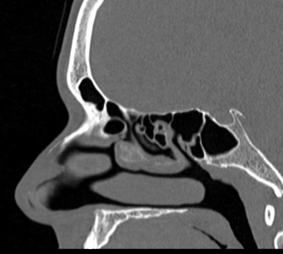 Angular epidermoid cyst (Radiopaedia 46908-51439 Sagittal bone window 49).png