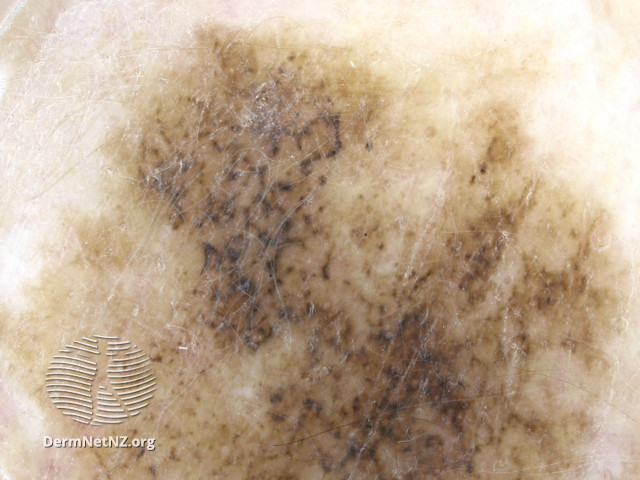 File:Annular granular pattern and rhomboids seen in dermoscopy of lentigo maligna melanoma (DermNet NZ lmm-8).jpg