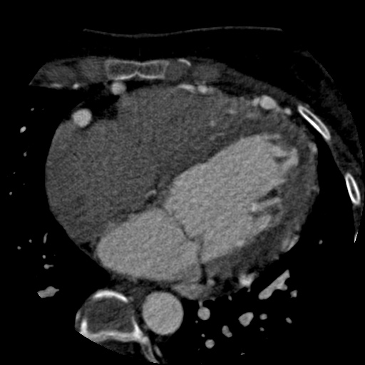 File:Anomalous left coronary artery from the pulmonary artery (ALCAPA) (Radiopaedia 40884-43586 A 49).jpg