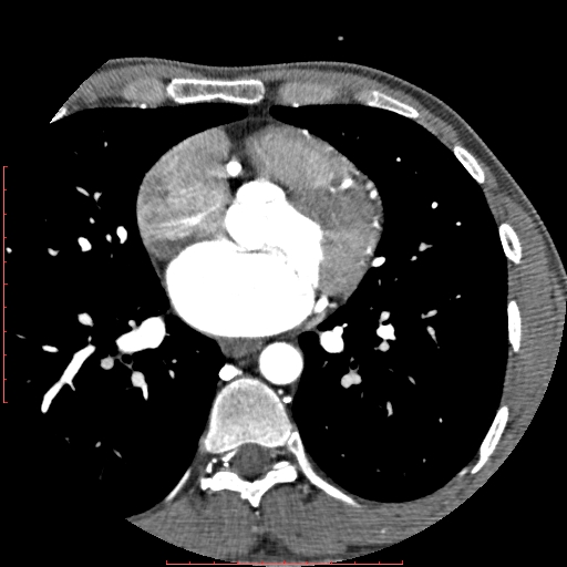 File:Anomalous left coronary artery from the pulmonary artery (ALCAPA) (Radiopaedia 70148-80181 A 157).jpg