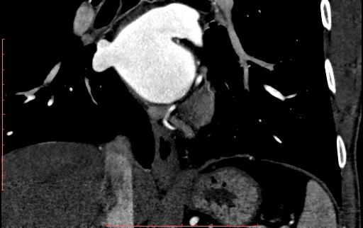 Anomalous left coronary artery from the pulmonary artery (ALCAPA) (Radiopaedia 70148-80181 B 218).jpg
