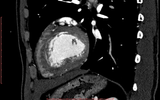 Anomalous left coronary artery from the pulmonary artery (ALCAPA) (Radiopaedia 70148-80181 C 187).jpg