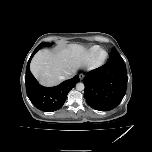 File:Anorectal carcinoma (Radiopaedia 44413-48064 A 6).jpg