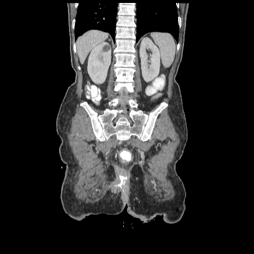 Anorectal carcinoma (Radiopaedia 44413-48064 B 66).jpg