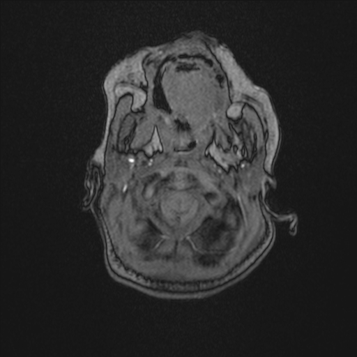File:Anoxic brain injury (Radiopaedia 79165-92139 Axial MRA 15).jpg