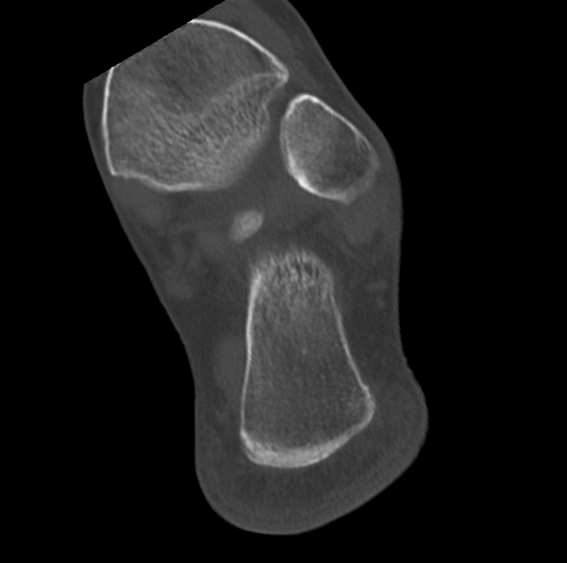 Anterior calcaneal process fracture (Radiopaedia 47384-51989 Coronal bone window 67).png