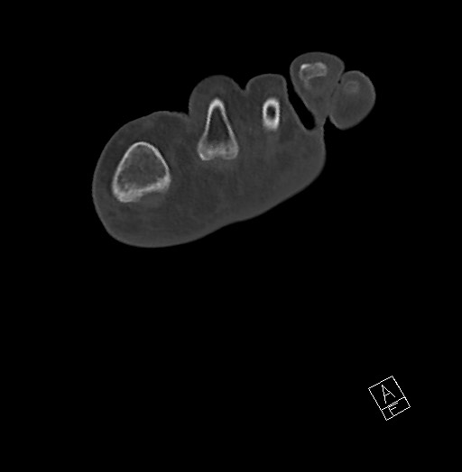 Anterior calcaneal process fracture (Radiopaedia 63353-71943 Axial bone window 34).jpg