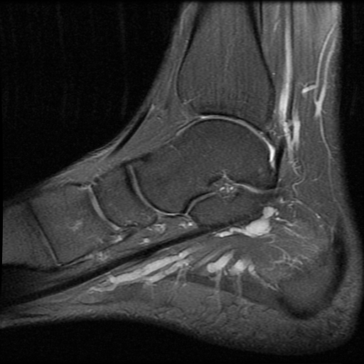 File:Anterior calcaneal process fracture (Radiopaedia 74654-85611 Sagittal PD fat sat 7).jpg