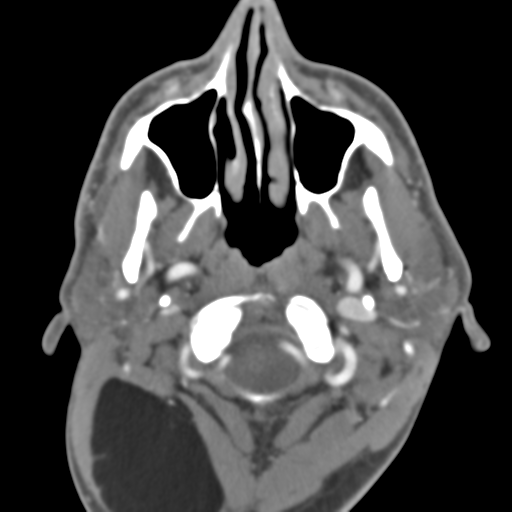 File:Anterior cerebral artery territory infarct (Radiopaedia 39327-41581 B 54).png