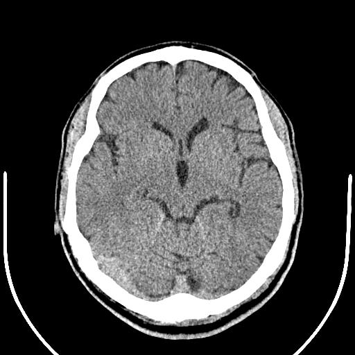 Anterior choroidal artery infarct (Radiopaedia 55106-61480 Axial non-contrast 24).jpg