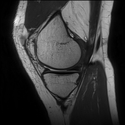 Anterior cruciate ligament rupture and posteromedial corner injury (Radiopaedia 67338-76723 Sagittal PD 52).jpg