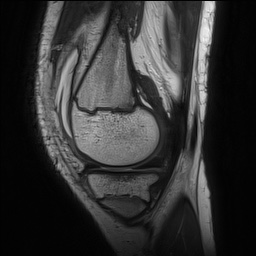 Anterior cruciate ligament tear - pediatric (Radiopaedia 62152-70260 Sagittal PD 52).jpg