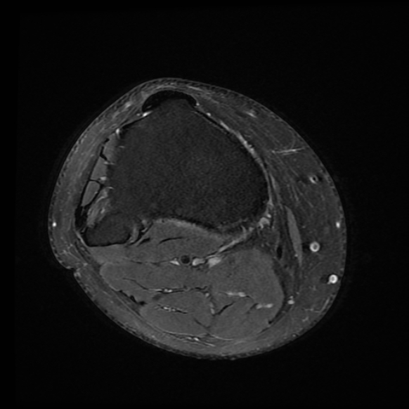 File:Anterior cruciate ligament tear with posteromedial corner injury, bucket-handle meniscal tear and chondral delamination (Radiopaedia 75501-86744 Axial PD fat sat 1).jpg